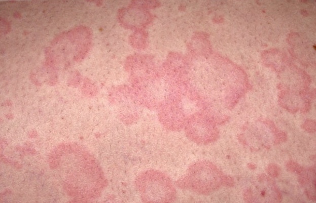 Аллергия на холод лечение и профилактика