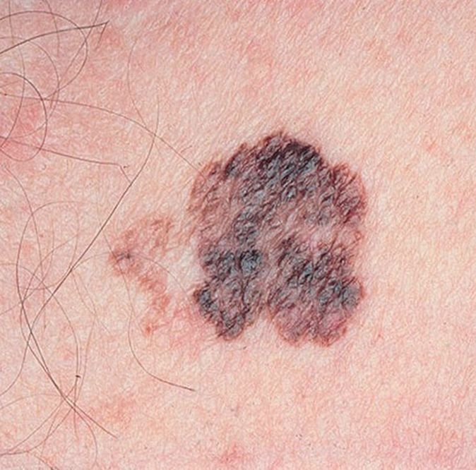 Признаки и лечение рака кожи