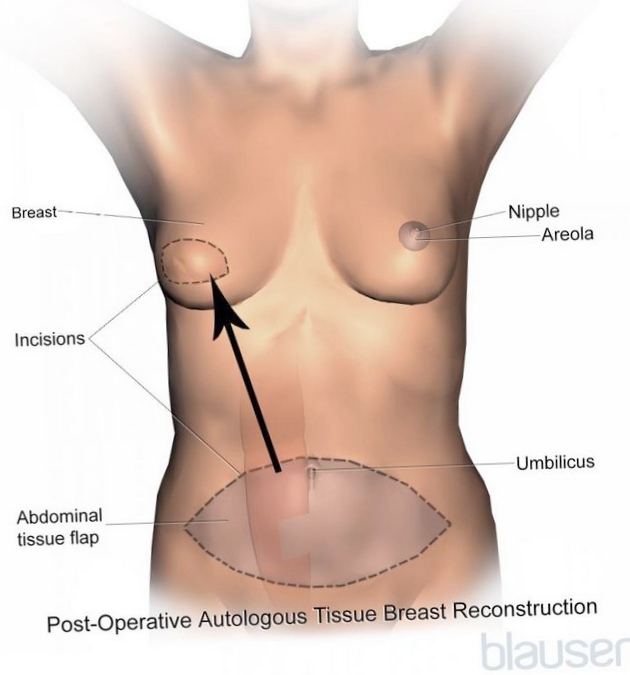 Сканирование рака груди приводит к ненужному лечению